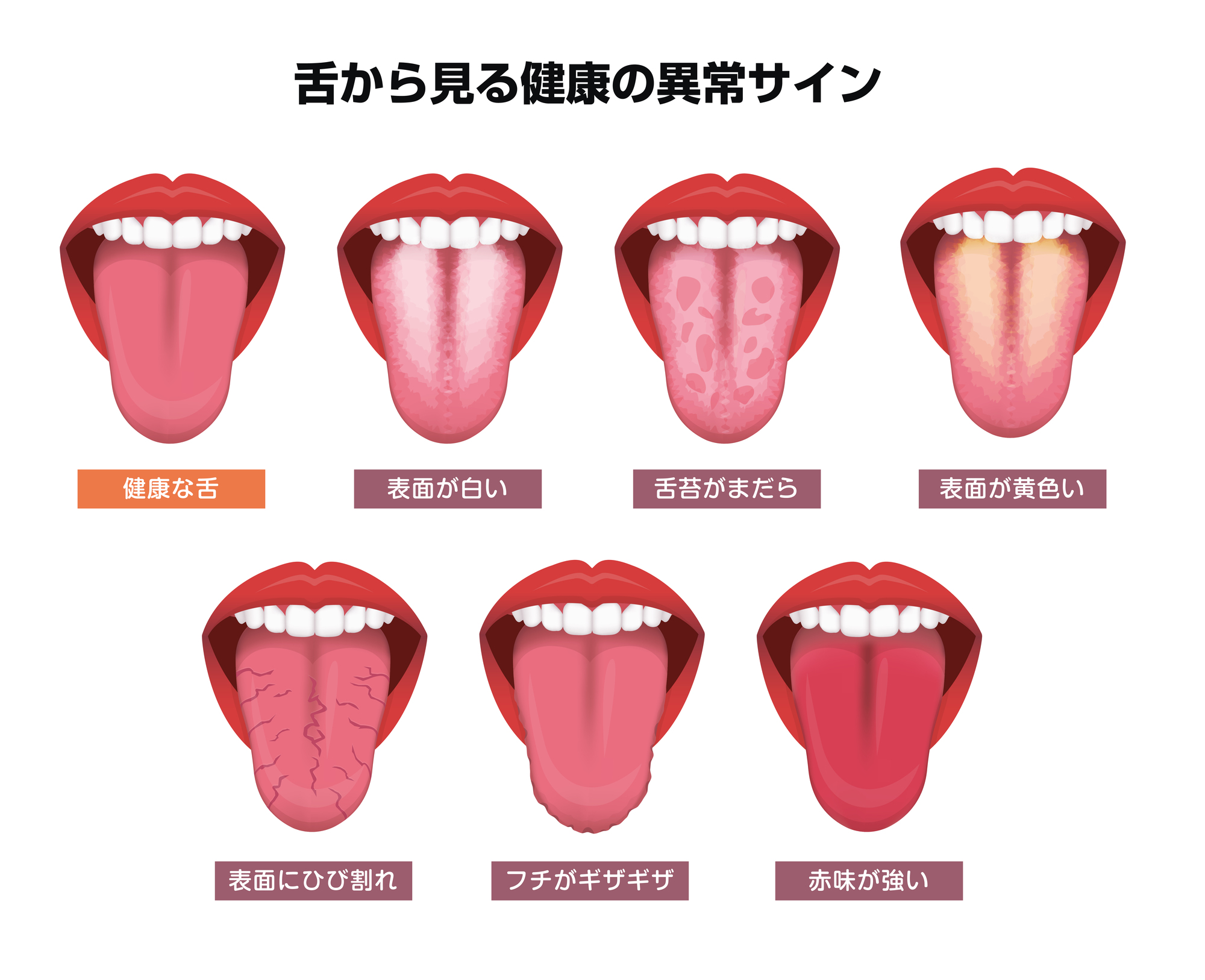 舌苔 つき やすい 人